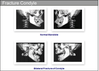 Craniofacial Deformities