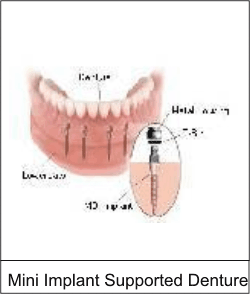 Dental Implants