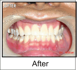 After Veneers