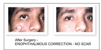 Ear Reconstruction Surgery