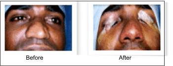 Rhinoplasty Surgery