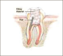 Root Canal Treatment