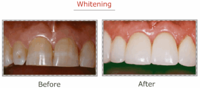Before Teeth Whitening