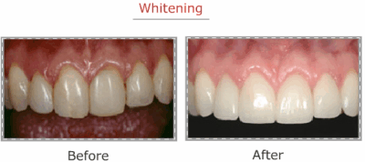 After Teeth Whitening