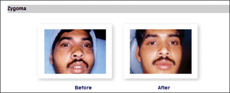 Before Multiple Implants