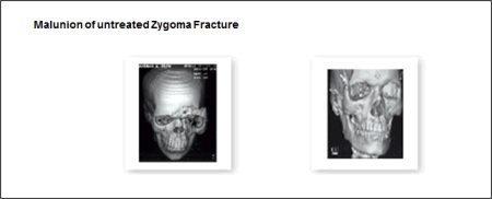 After Multiple Implants